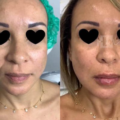 bigode chines - harmonin harmonizacao facial (1)