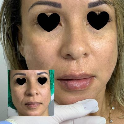 bigode chines - harmonin harmonizacao facial (2)