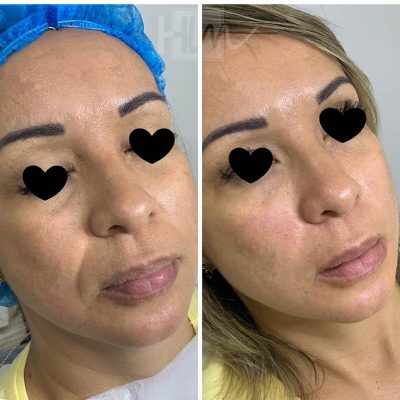 bigode chines - harmonin harmonizacao facial (3)