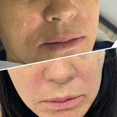 bigode chines - harmonin harmonizacao facial (4)