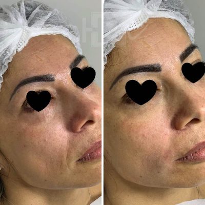 bigode chines - harmonin harmonizacao facial (5)