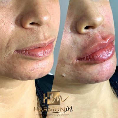 labios - harmonin harmonizacao facial (11)