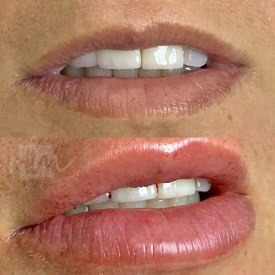 labios - harmonin harmonizacao facial (12)