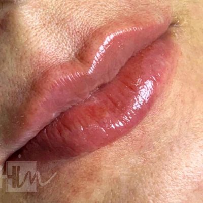 labios - harmonin harmonizacao facial (13)