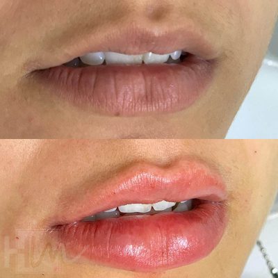 labios - harmonin harmonizacao facial (14)