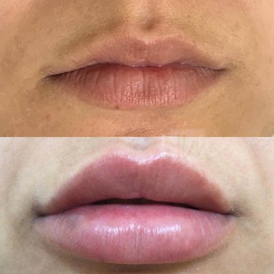 labios - harmonin harmonizacao facial (15)
