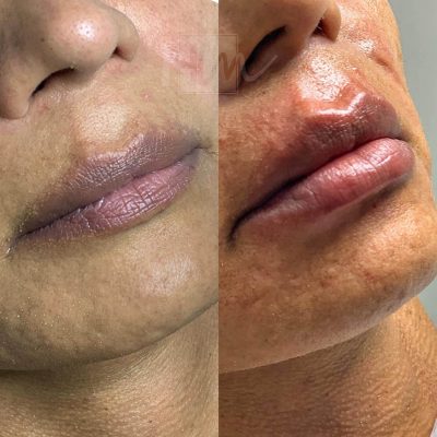 labios - harmonin harmonizacao facial (16)