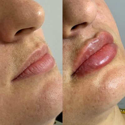 labios - harmonin harmonizacao facial (17)