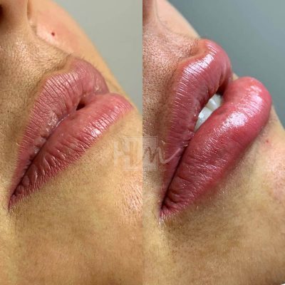 labios - harmonin harmonizacao facial (18)