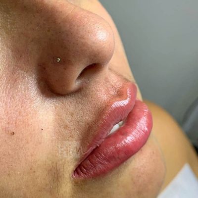 labios - harmonin harmonizacao facial (19)