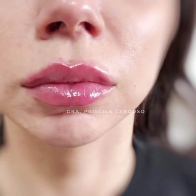 labios - harmonin harmonizacao facial (2)