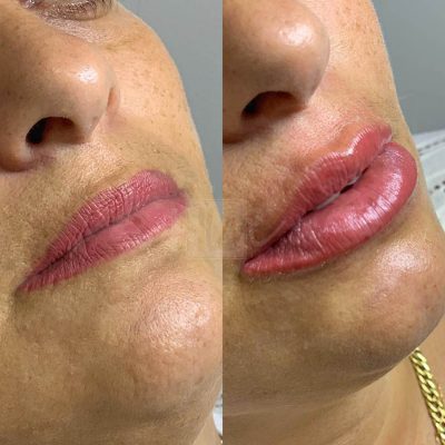 labios - harmonin harmonizacao facial (20)