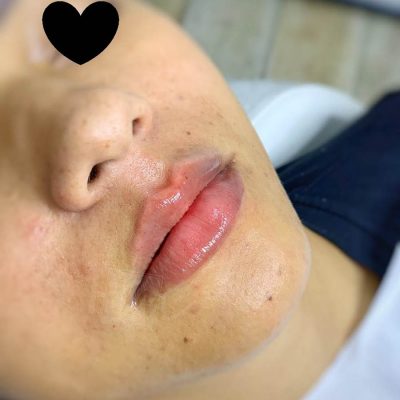 labios - harmonin harmonizacao facial (21)