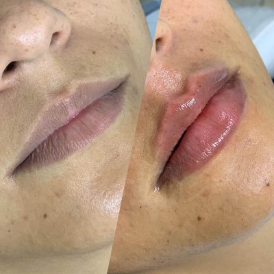 labios - harmonin harmonizacao facial (3)