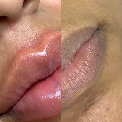labios - harmonin harmonizacao facial (5)
