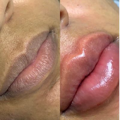 labios - harmonin harmonizacao facial (6)