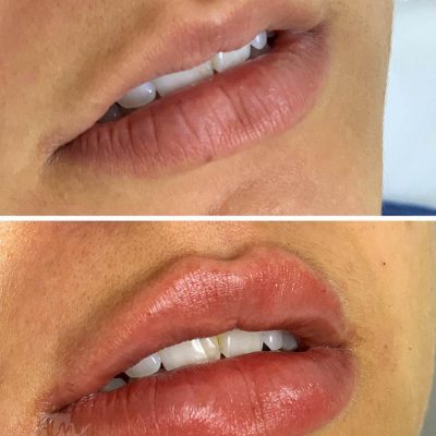 labios - harmonin harmonizacao facial (7)