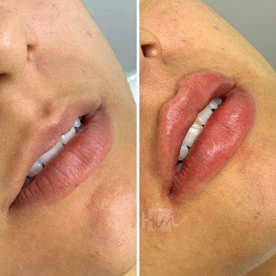 labios - harmonin harmonizacao facial (8)