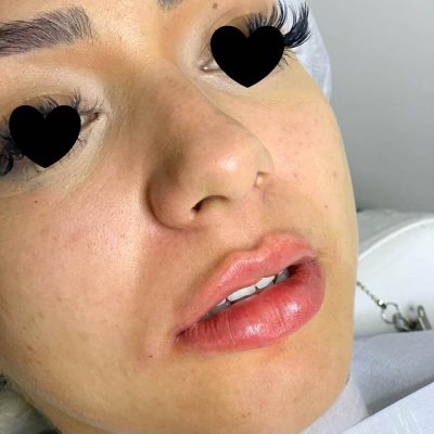 labios - harmonin harmonizacao facial (9)