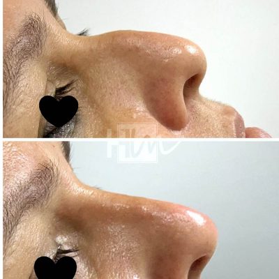 nariz - harmonin harmonizacao facial (1)