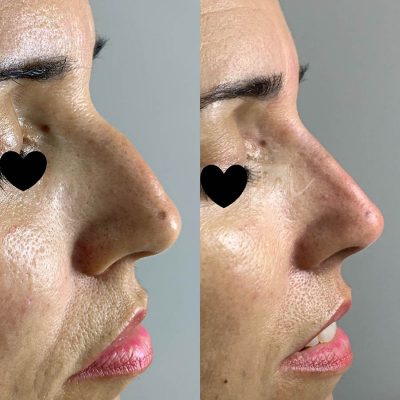 nariz - harmonin harmonizacao facial (3)