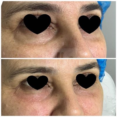 olheiras - harmonin harmonizacao facial (2)