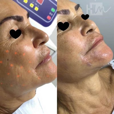 prevencao de rugas - harmonin harmonizacao facial (1)