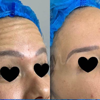 prevencao de rugas - harmonin harmonizacao facial (2)