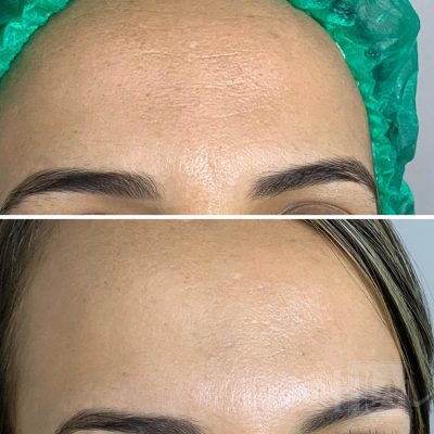 prevencao de rugas - harmonin harmonizacao facial (3)