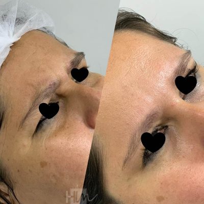 prevencao de rugas - harmonin harmonizacao facial (4)
