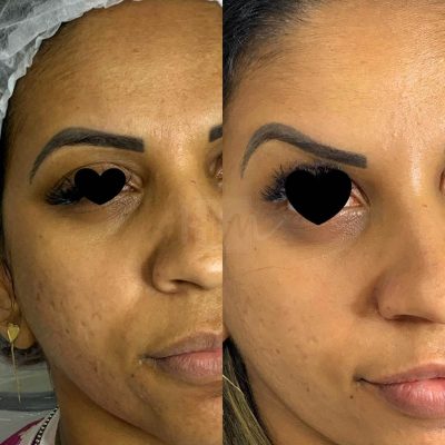 prevencao de rugas - harmonin harmonizacao facial (5)