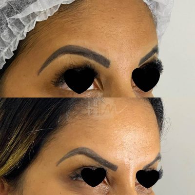 prevencao de rugas - harmonin harmonizacao facial (6)
