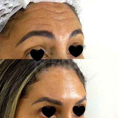 prevencao de rugas - harmonin harmonizacao facial (8)