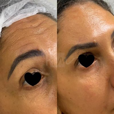 prevencao de rugas - harmonin harmonizacao facial (9)